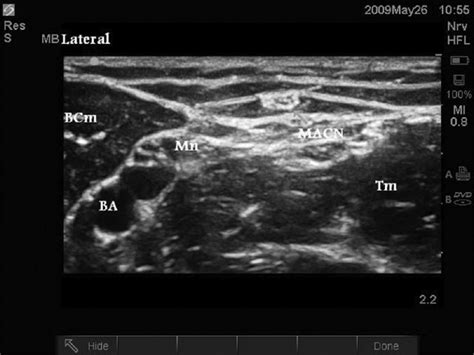 Lateral Antebrachial Cutaneous Nerve Anatomy
