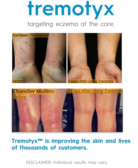 Tremotyx Stem Cell Eczema Cream Instant Relief For Eczema