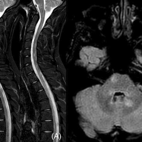 A Spinal Magnetic Resonance Imaging Mri Shows Non‐enhancing Spinal