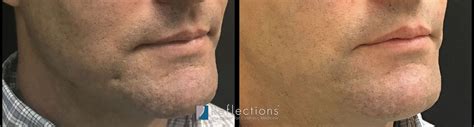 Subcision With Filler For Deep Acne Scar Before And After Photos New Jersey Reflections Center