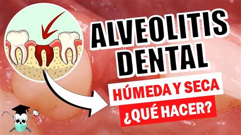 Alveolitis Dental ¿qué Debo Hacer Causas Y Soluciones Youtube