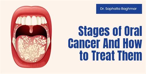 Stages Of Oral Cancer And How To Treat Them Dr Saphalta Baghmar