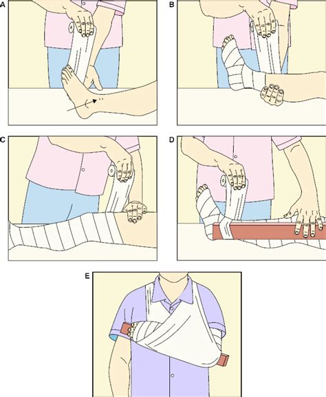 2 Pressure Immobilization First Aid Ac Commencing Distal To Bite