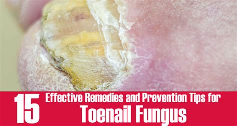 15 Diy Home Remedies For Toenail Fungus