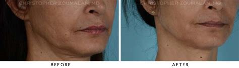 Fillers For Facial Rejuvenation Before And After Photo Gallery