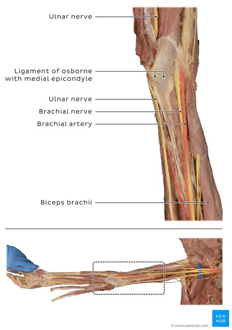 Ulnar Nerve Subluxation Clinical Anatomy Kenhub