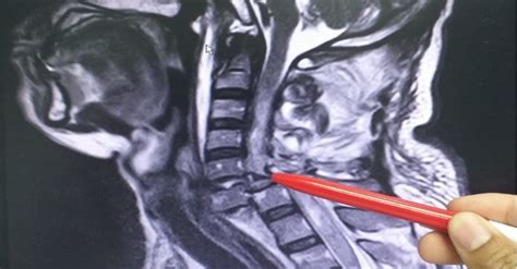 How To Read An Mri Of The Cervical Spine