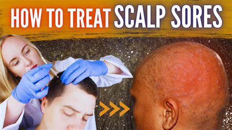 scalp scabs causes symptoms and how to heal no body p