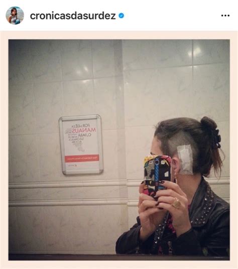 Queda De Cabelo Por Eflúvio Telógeno Crônico: A Minha Experiência