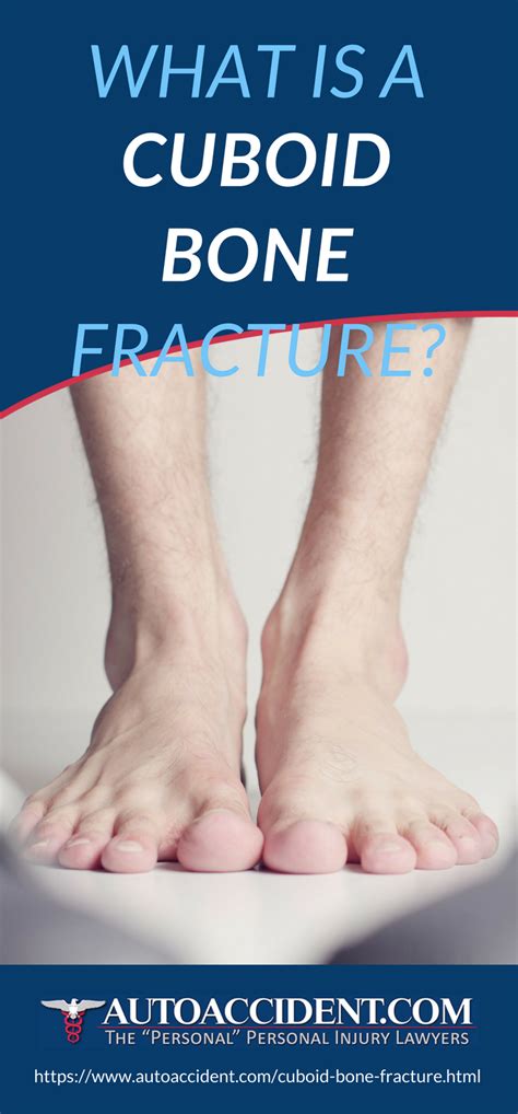 Cuboid Bone Fracture Here Are The Things You Need To Know About A