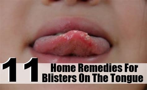 Top 11 Home Remedies For Blisters On The Tongue Search Herbal And Home
