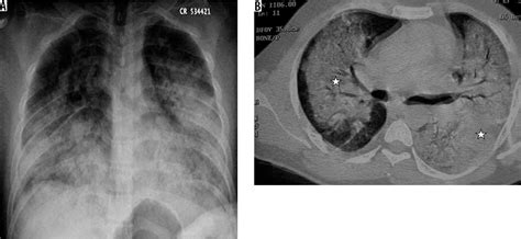 Pneumonia Chest X Ray Radiopaedia Pneumonia 2020