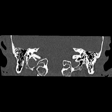 Normal Petrous Temporal Bone Ct Image