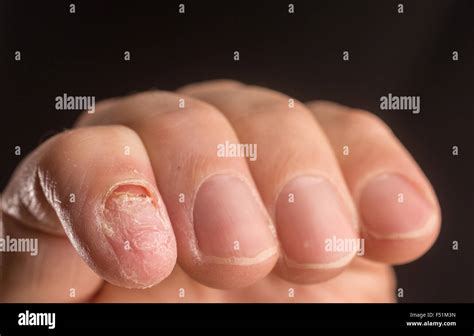 Man Injury Hand Finger Hi Res Stock Photography And Images Alamy