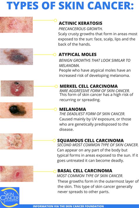 Skin Cancer Puget Sound Dermatology Career Zone 7