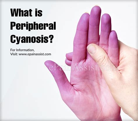 What Is Peripheral Cyanosiscausessymptomstreatmentsdiagnosis