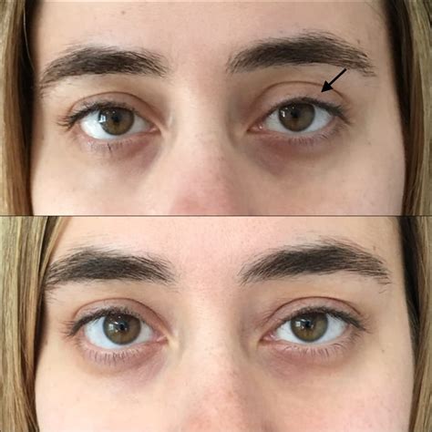 Eyelid Filler Before And After Photos Flora Levin Md