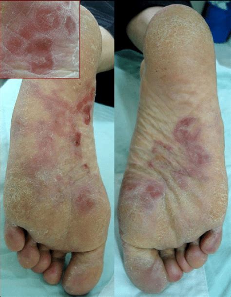 Symmetrical Well Demarcated Painful Erythema And Bullous Lesions On