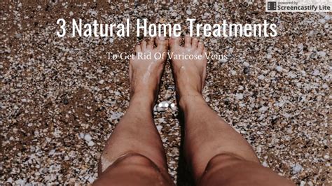 3 Easy Natural Home Treatments To Get Rid Of Varicose