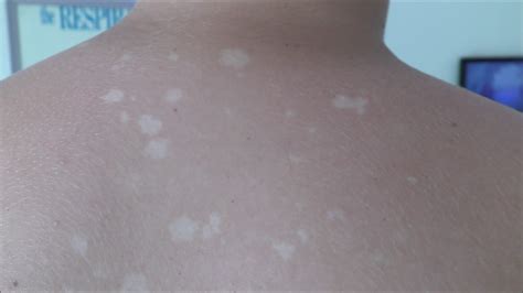 White Patches On Skin This Is A Case Of Pityriasis Versicolor Youtube