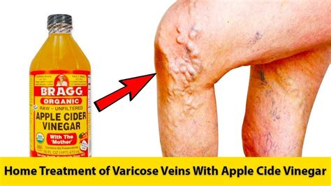 Home Treatment Of Varicose Veins With Apple Cide Vinegar Get Rid Of