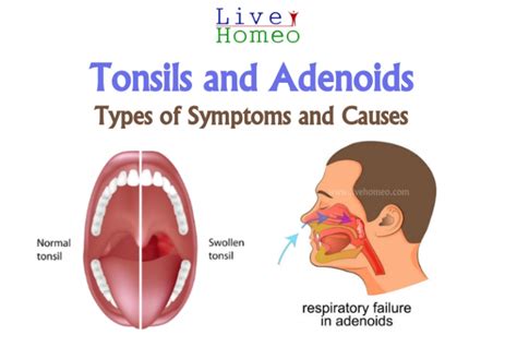 Tonsils And Adenoids Types Of Symptoms And Causes Live Homeo