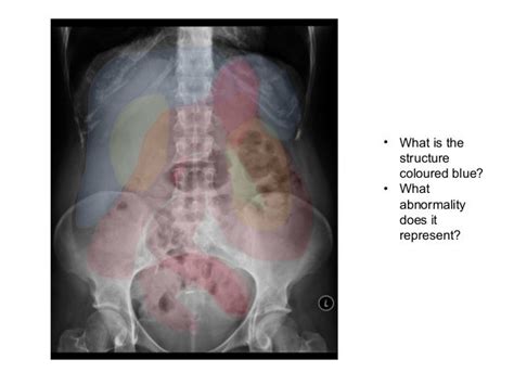 Introduction To Abdominal X Ray Interpretation