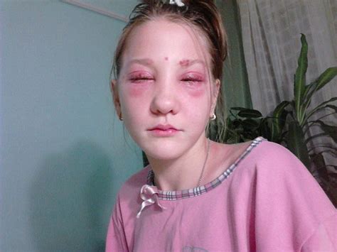 Russian Teen Left Partially Blind And Suffering Chemical Burns After