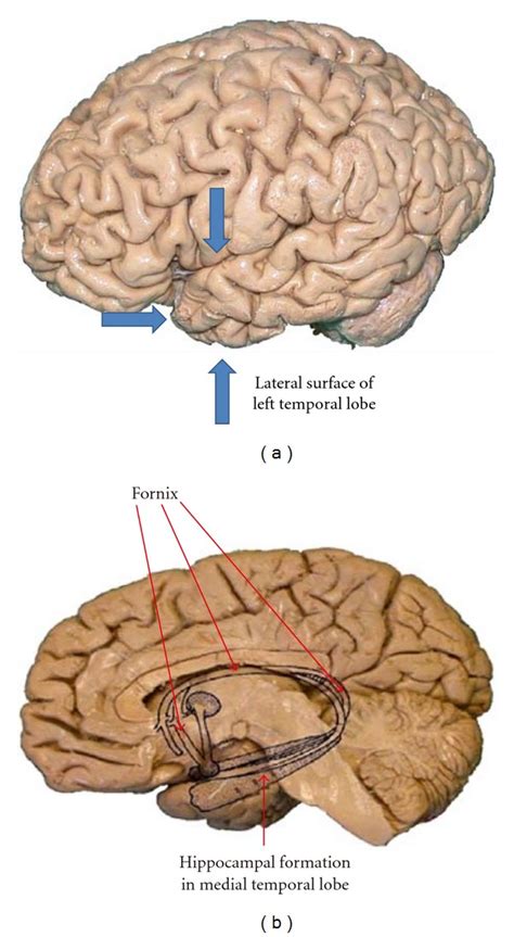 Lateral A And Mesial B Surfaces Of Temporal Lobe Courtesy Of Dr