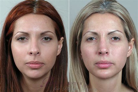 Cheek Chin Implants Before And After Pictures Case Paramus Nj