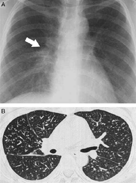 Miliary Tuberculosis In A 31 Year Old Female Who Underwent Allogeneic