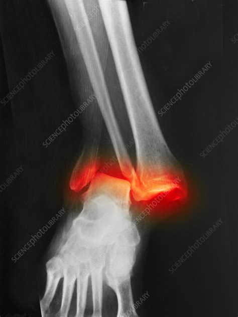 Fractured And Dislocated Ankle Stock Image C0094783 Science