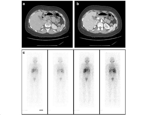 A Abdomen Computed Tomography Axial Image With Contrast Enhancement