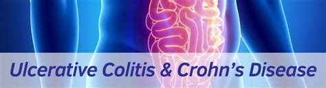 Exeter Gut Clinic Ulcerative Colitis Chrohns Disease Treatment Header
