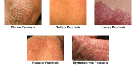 Psoriasis Treatment