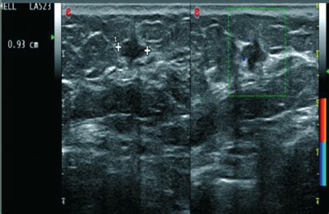 Ultrasound Examination Right Breast Showing A Hypoechoic Round Nodule