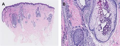 Eosinophilic Pustular Folliculitis And Secondary Syphilis Ccid