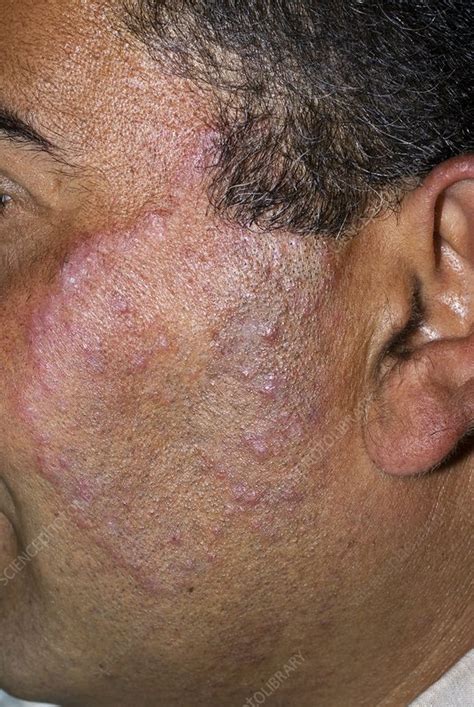 Tinea Fungal Infection On The Face Stock Image C0103378 Science