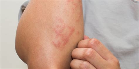 New In Covid 19 Skin Rashes Linked To Virus The Womens Journal