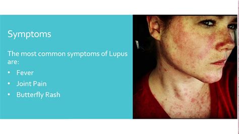 Systemic Lupus Erythematosus Youtube