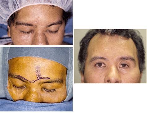 Scar Revision Dallas Ophthalmology Surgeons Texas Ophthalmic