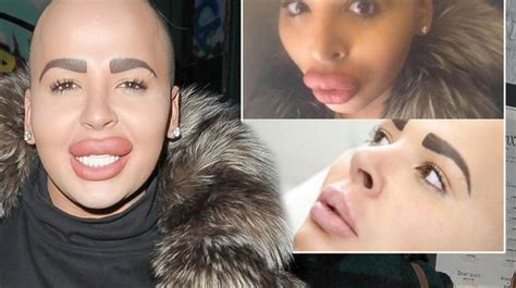Kim Kardashian Wannabe Has Cosmetically Enhanced Pout Reduced After