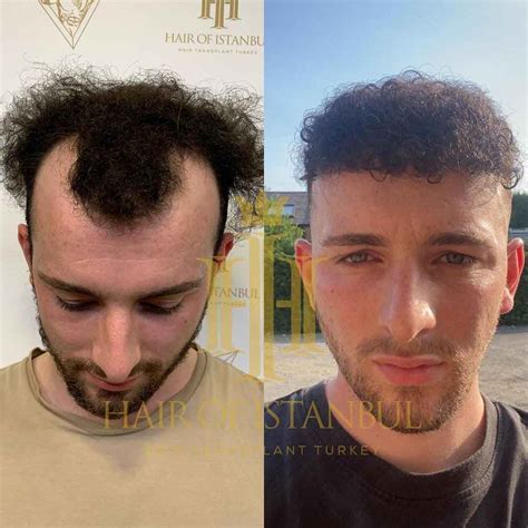 Hair Of Istanbul Hair Transplant Review And Cost Hairanalyse