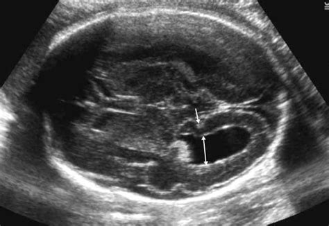 Fetal Cerebral Ventricular Measurement And Ventriculomegaly Time For