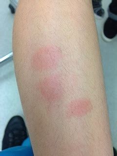 突然みられた円形の赤い湿疹｜野田市 小児科 千葉県 こどもの ...