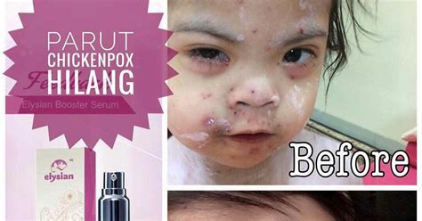 Chicken pox or varicella is highly contagious disease caused by varicella zoster virus. SueShaem : PARUT CHICKEN POX HILANG DENGAN ELYSIAN SERUM