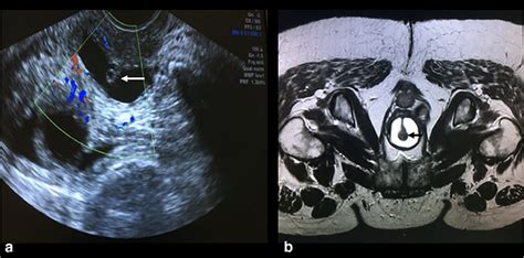 A Transvaginal Ultrasound Showing The Urethra Surrounded By The Hot Sex Picture