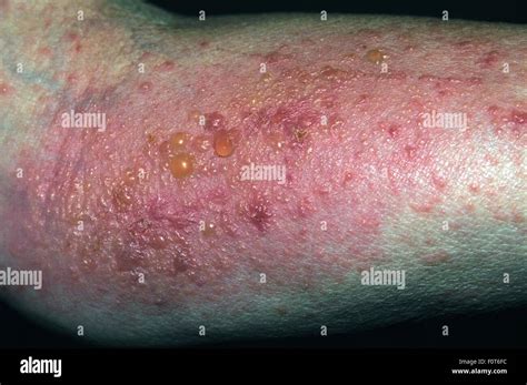 Poison Ivy Blisters On A Womans Arm Stock Photo Alamy