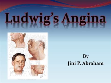 Ludwigs Angina Certified Fixed Orthodontic Courses By Indian Dental