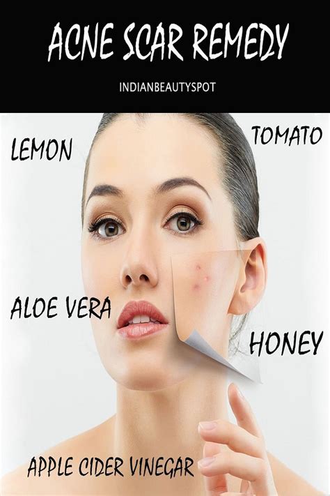 30 Natural Home Remedies To Heal Acne Scars Overnigh